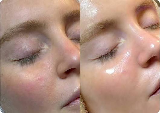 Before and after HydraFacial result - Case 1