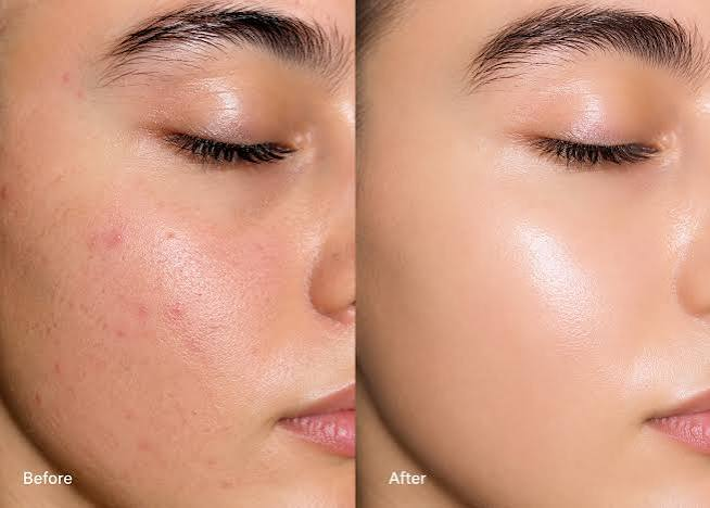 Before and after HydraFacial result - Case 2