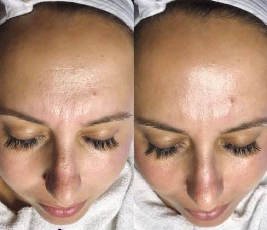 Before and after HydraFacial result - Case 3